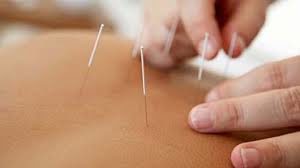 Acupuncture
